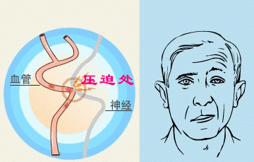 面瘫有什么症状表现 早期症状(面瘫有什么症状表现)-第2张图片-