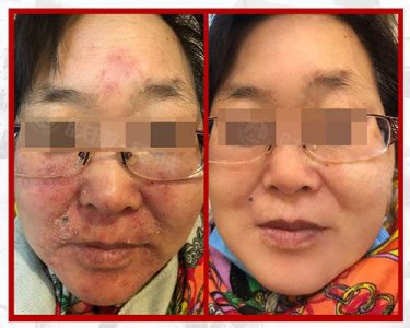 ​脸部过敏红肿怎么办？泛红、瘙痒动不动就“脸红”谨记这三点