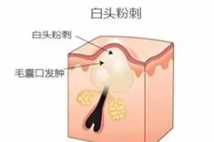 闭口是怎么引起的？4种情况要注意