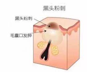 闭口是怎么引起的？4种情况要注意