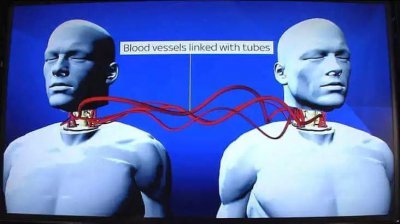 ​换头手术宣布成功？换个身体就可以继续生存了？