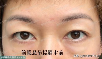 ​49岁女士做提眉手术，术前，术后恢复过程，术后13天高清对比