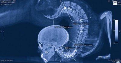 ​X射线下的医学照片：原来患有肺气肿吸烟者的肺如此恐怖